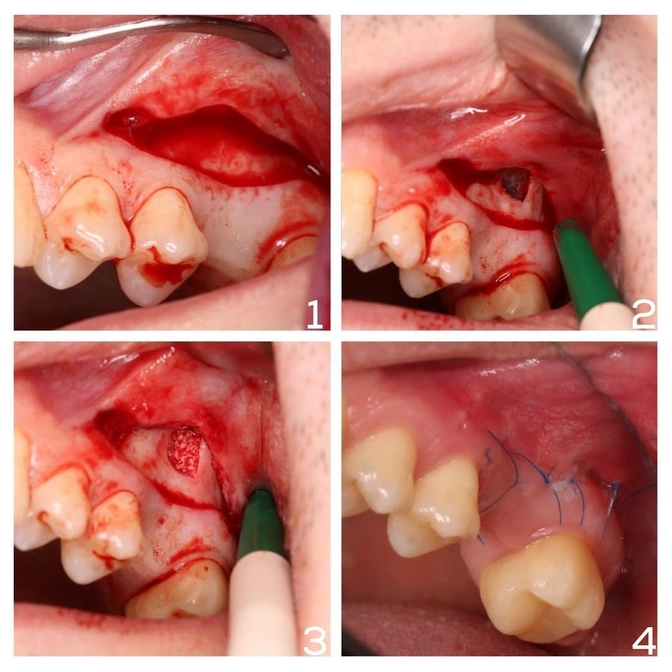 Если для импланта не хватает костной ткани...