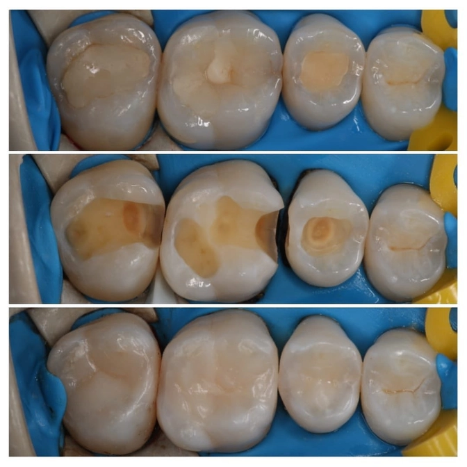 Плановая замена старых пломб 