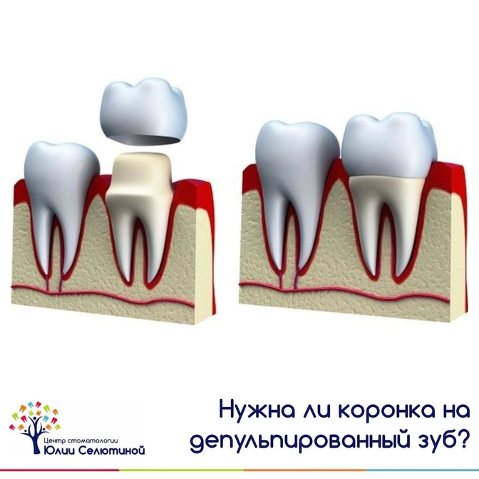 Нужна ли коронка на депульпированный зуб? 