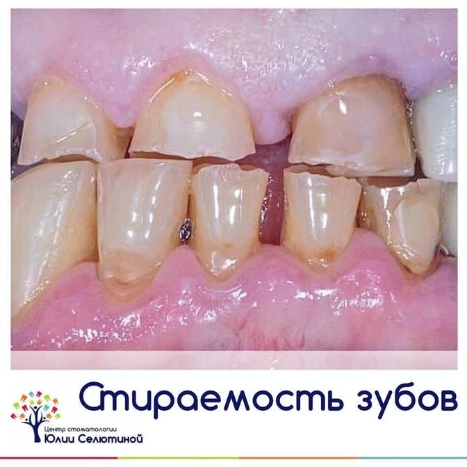 Стираемость зубов.  