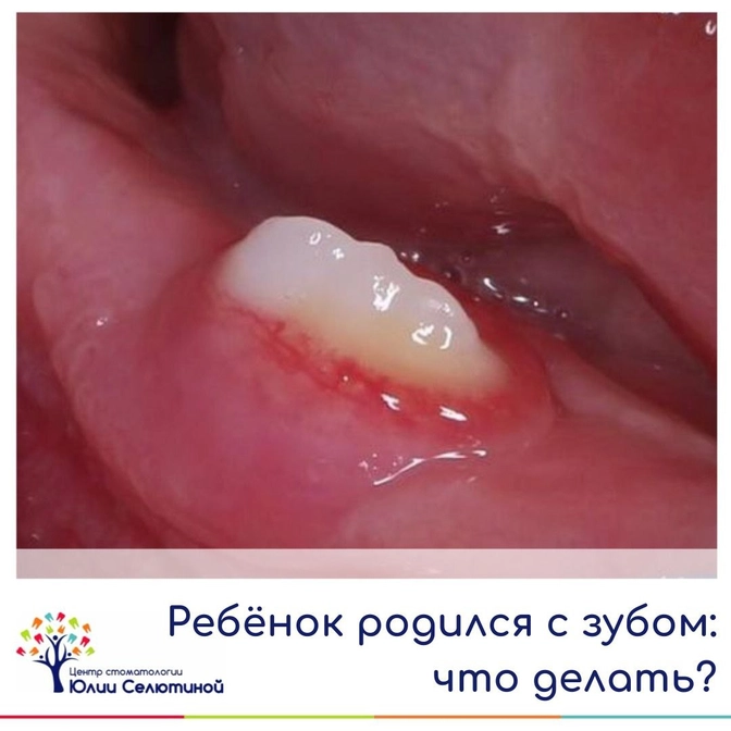 Ребенок родился с зубом. Что делать?..