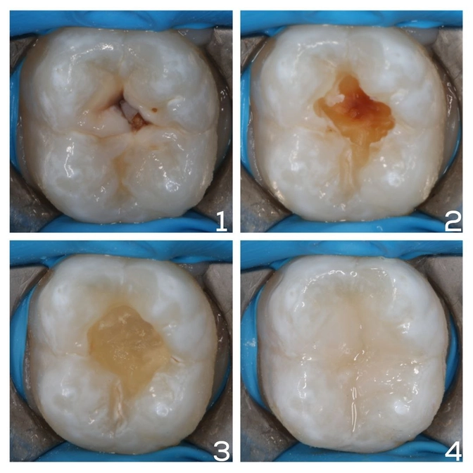 Каким глубоким может оказаться кариес!