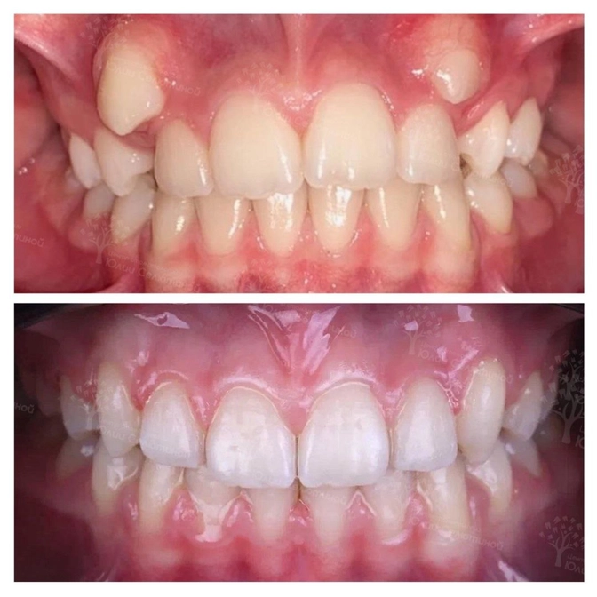 Возраст пациента и сроки лечения на брекет-системе: какова связь? 