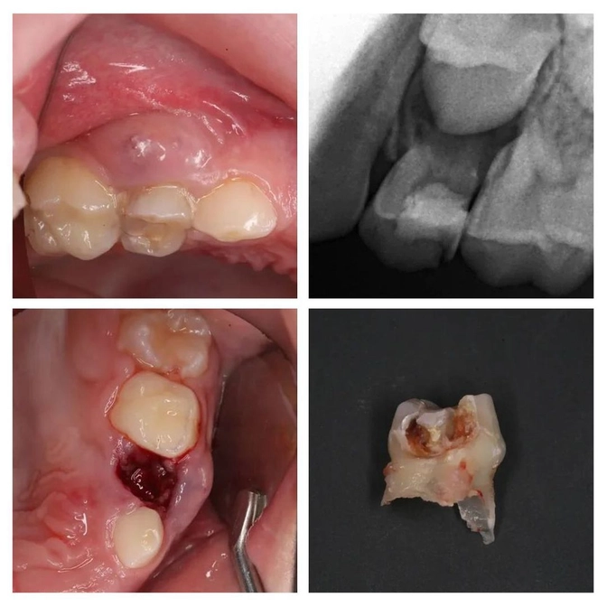 Свищ у молочного зуба: что делать? 