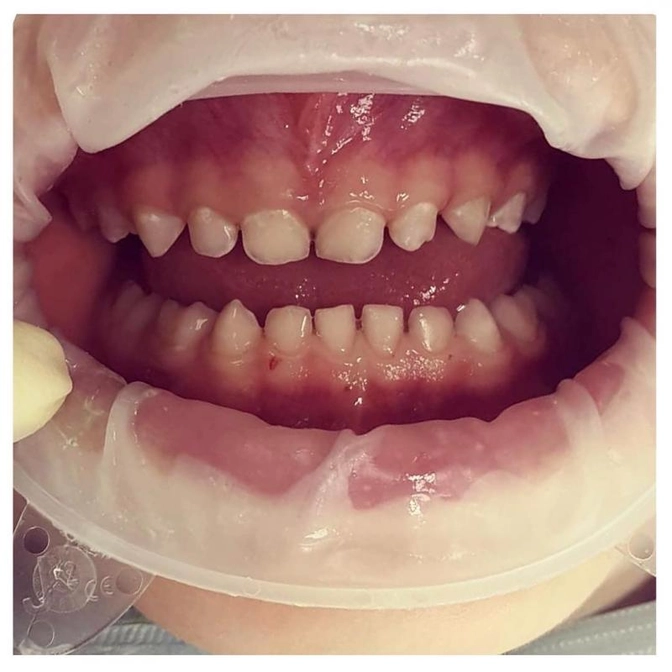 Как часто посещать детского стоматолога?