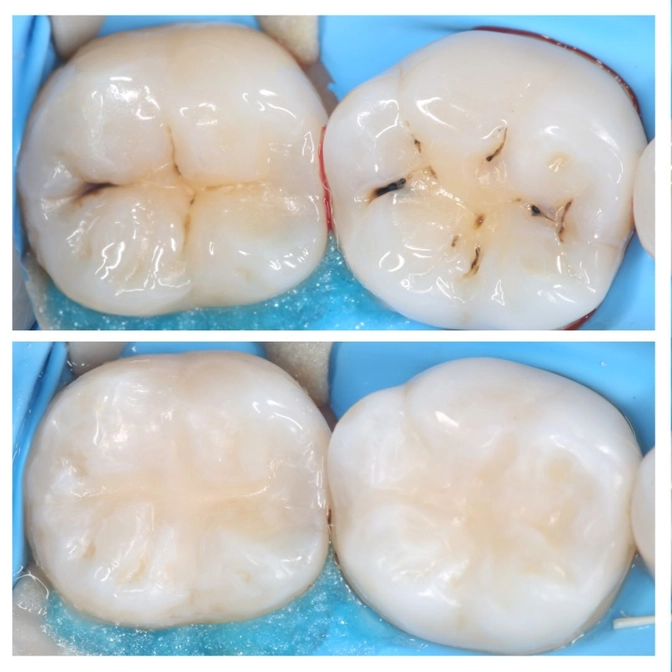 Фиссурный кариес 