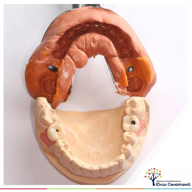 Как изготавливается коронка? 