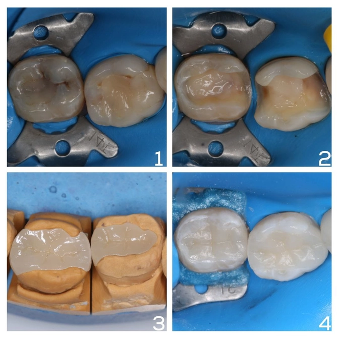 Замена старых пломб вкладками 