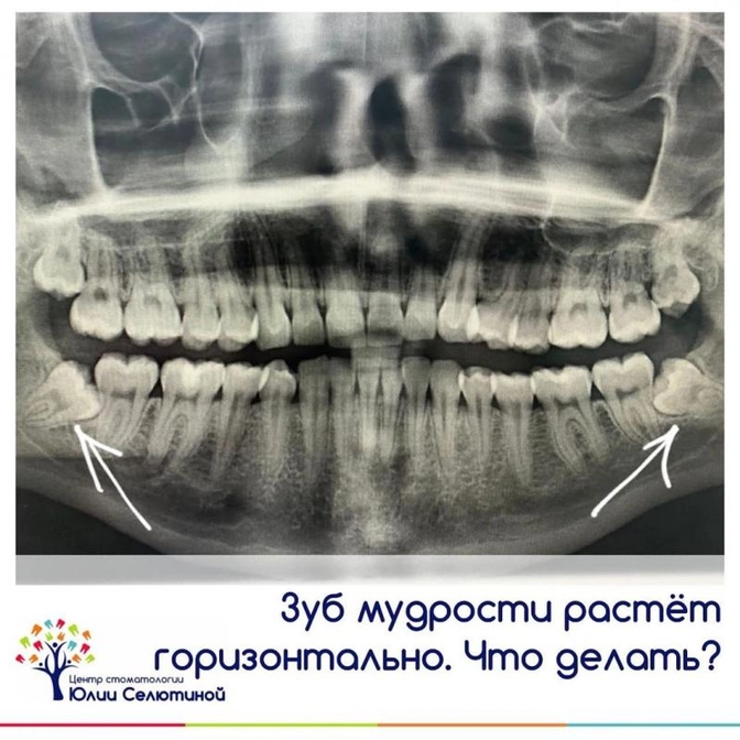 Нужно ли удалять зубы "мудрости"?