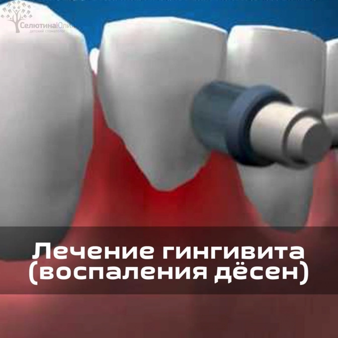Лечение гингивита