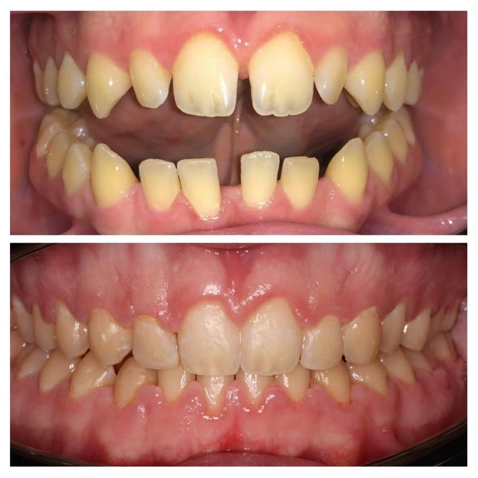 Результаты ор тодонтического лечения открытого прикуса