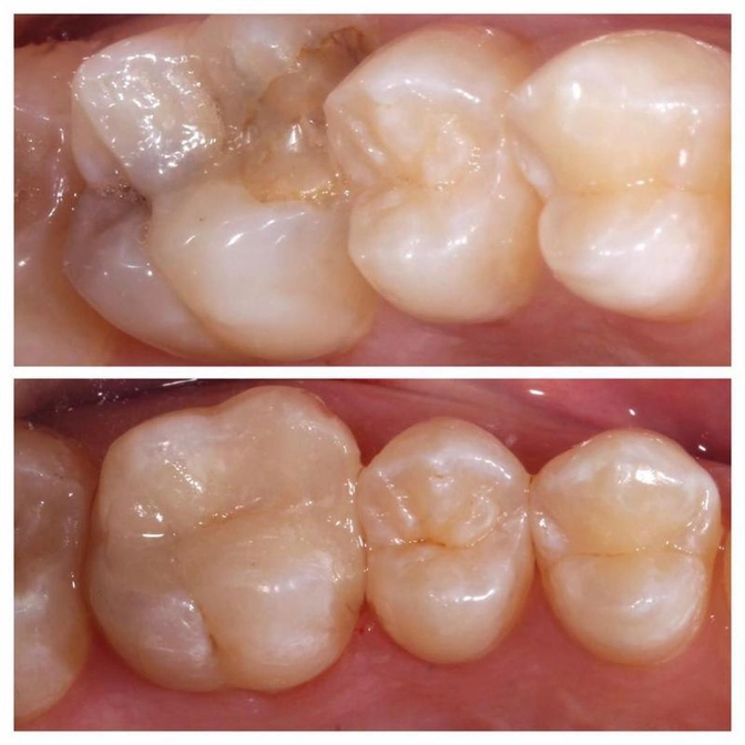 Керамическая вкладка - что это?