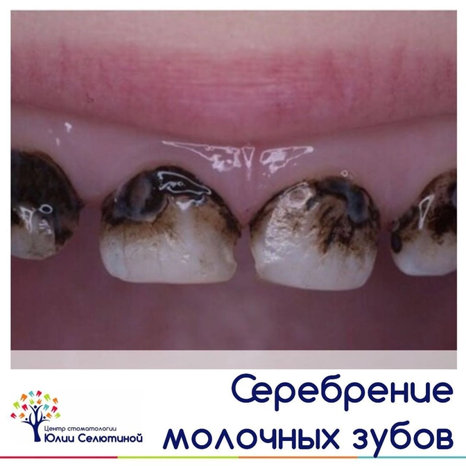 Почему я не рекомендую серебрение зубов?