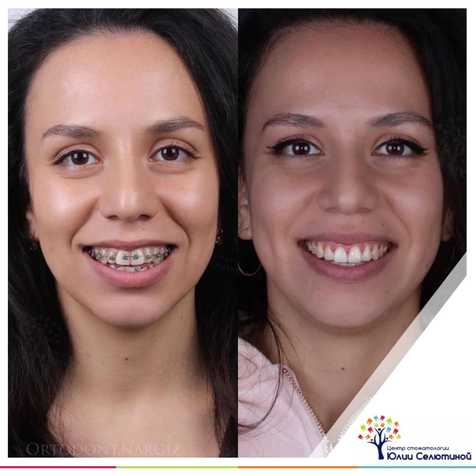 Результат после брекет-лечения 