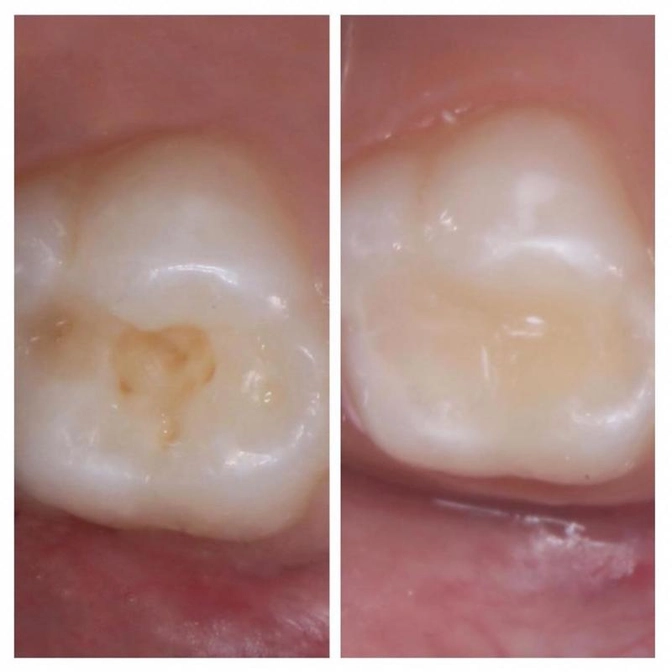 Обманчивый кариес.