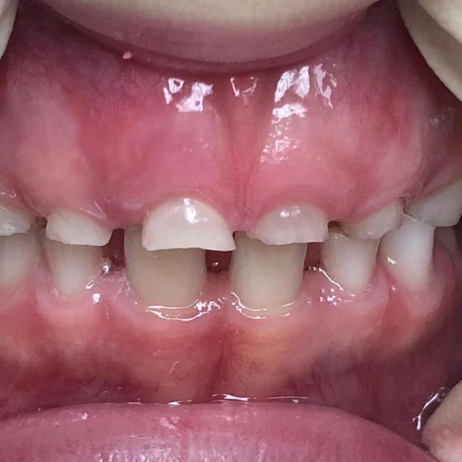 Патологическая стираемость зубов.