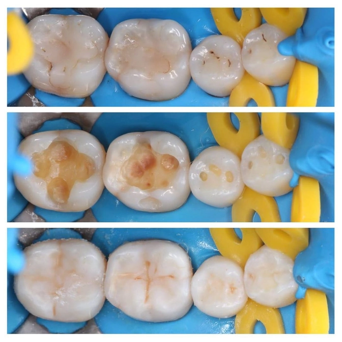 Лечение 4 зубов за одно посещение! 