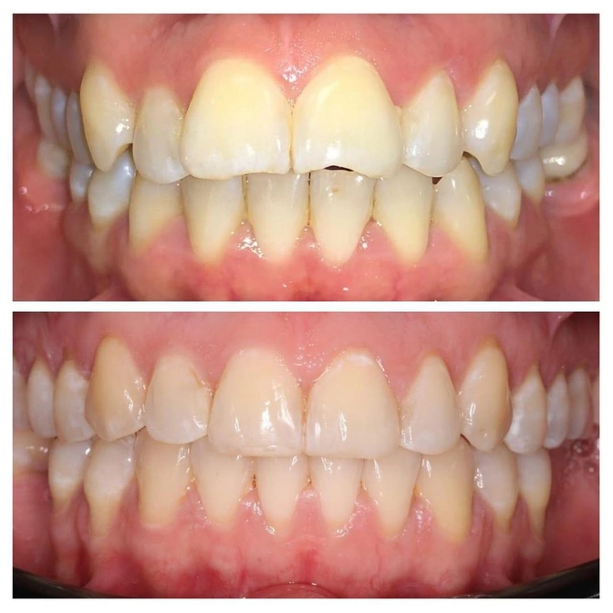 Открытый прикус: лечение за 13 месяцев.