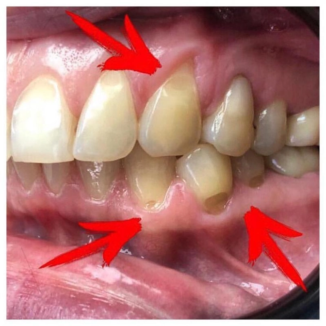 Абфракционный дефект зубов.