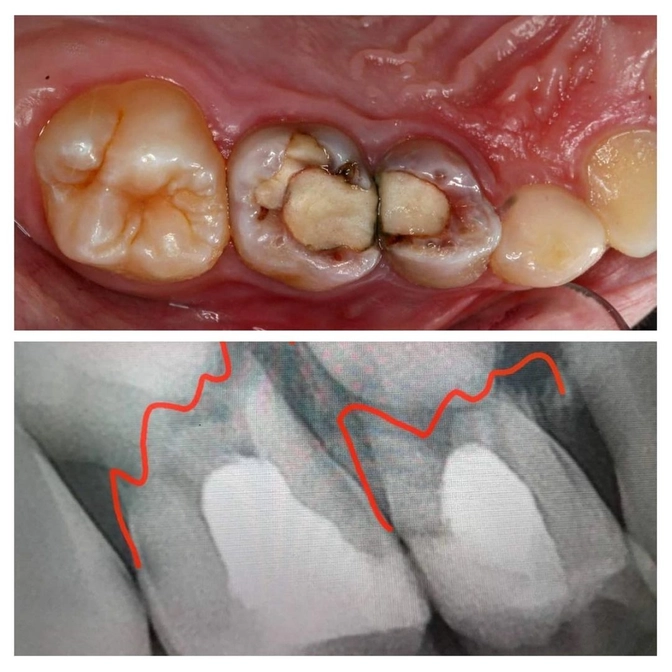 Что бывает с молочными зубами, пролеченными резорцин-формалиновым методом ?