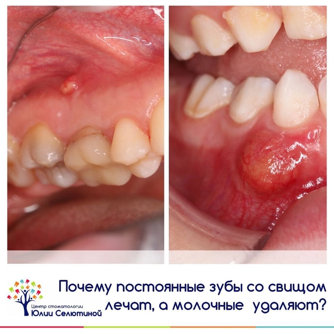 Почему постоянные зубы со свищом лечат, а молочные удаляют? 