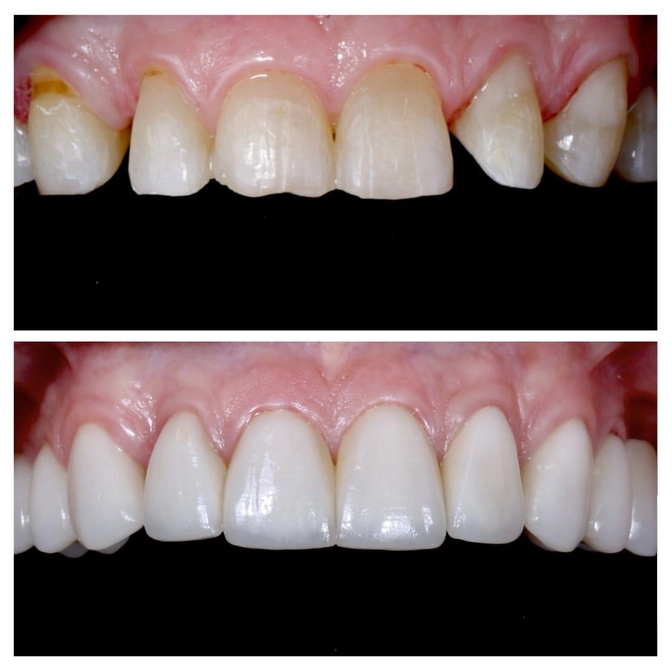 Преображение улыбки 