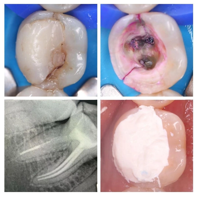 Когда зуб не спасти..