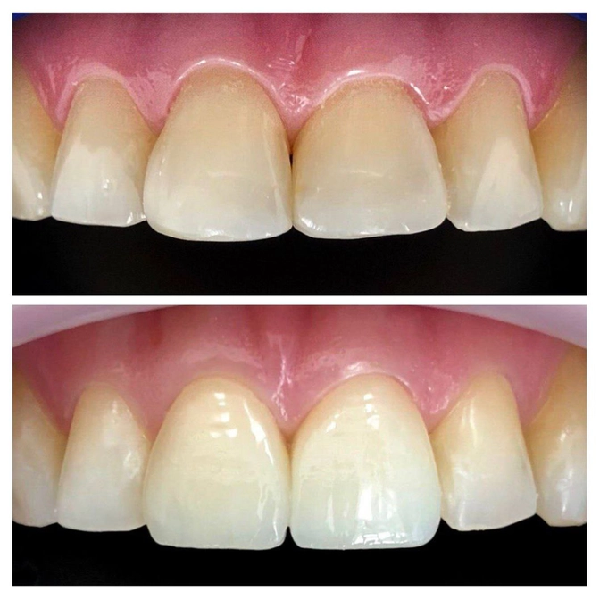 Композитные реставрации и керамические виниры: преимущества и недостатки 