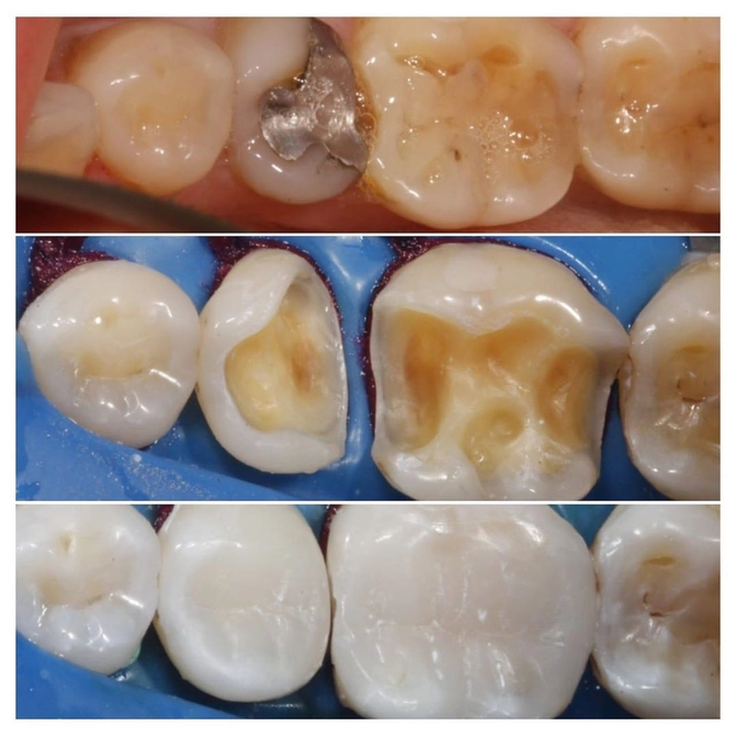 Зачем менять старые пломбы?