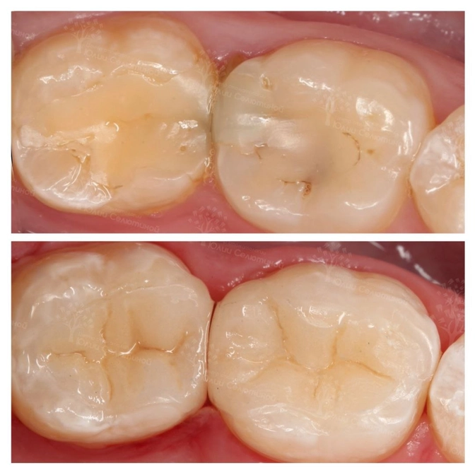 Клинический случай: замена пломб керамическими вкладками 