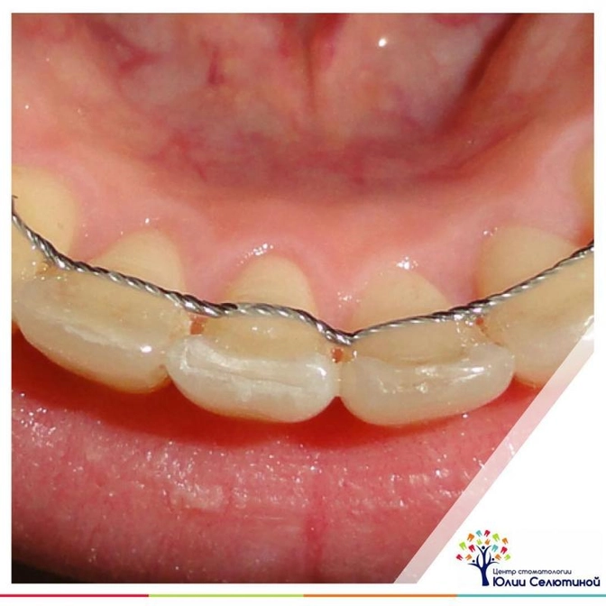 А что после брекетов?