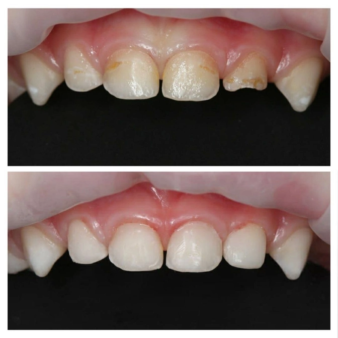 Лечение зубов малышки под наркозом. 