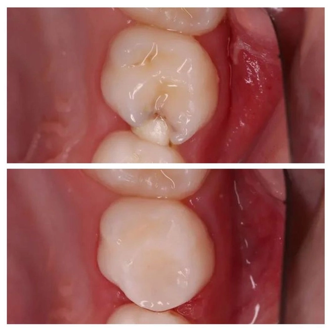 Замена несостоятельной пломбы 