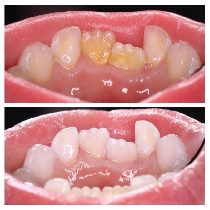 Зубной камень на молочных зубах. 