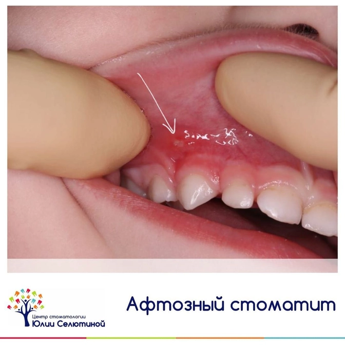 Афтозный стоматит 