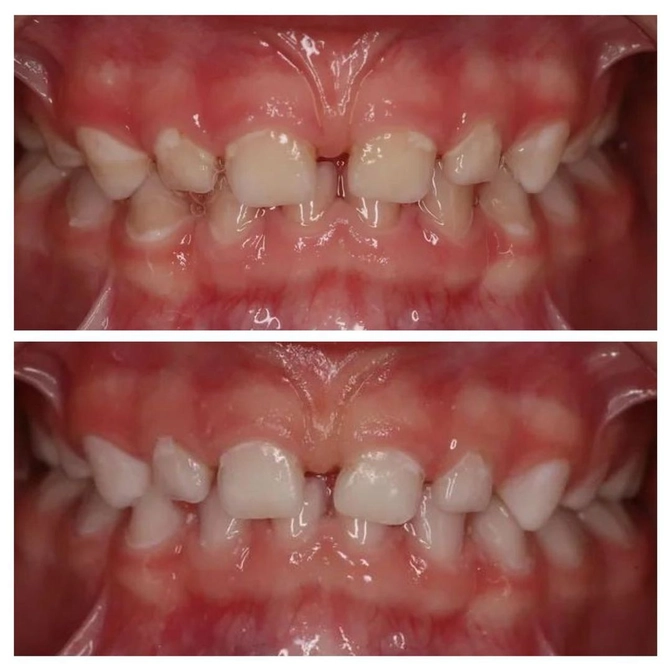 О важности налаженной гигиены полости рта у детей. 