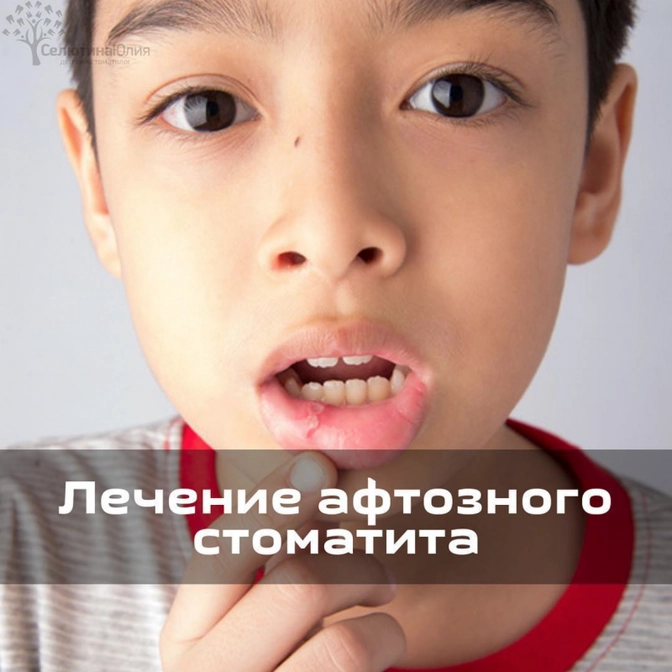 Лечение афтозного стоматита