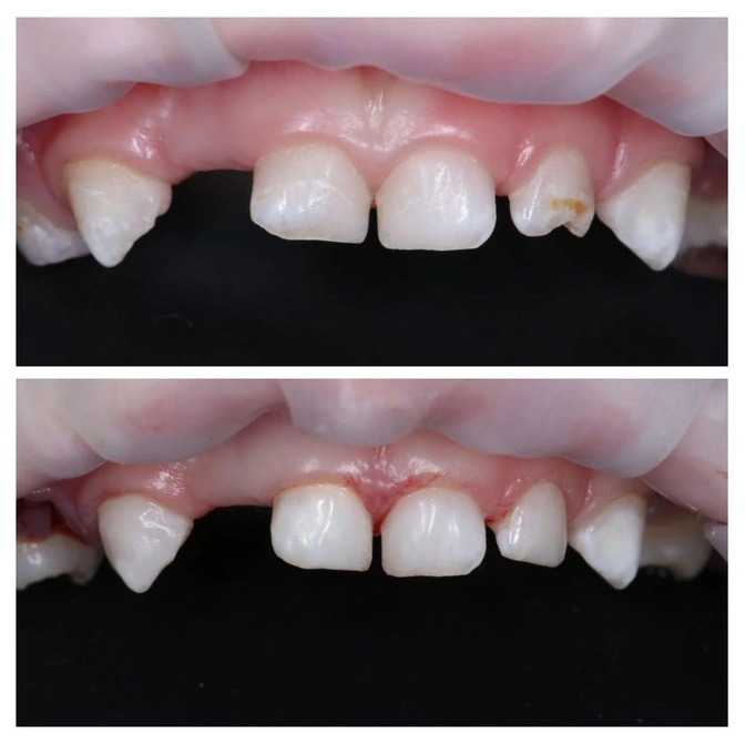 Лечение молочных зубов под наркозом. 