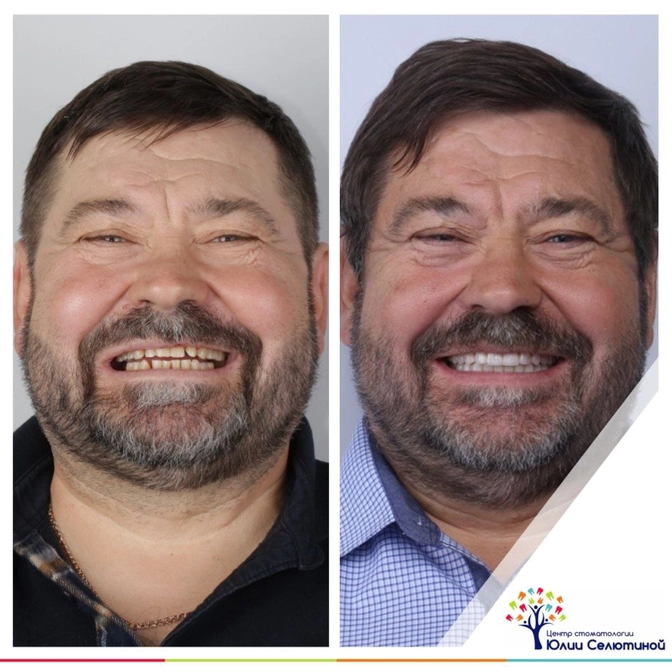 Тотальная реабилитация: функция и эстетика у возрастных пациентов