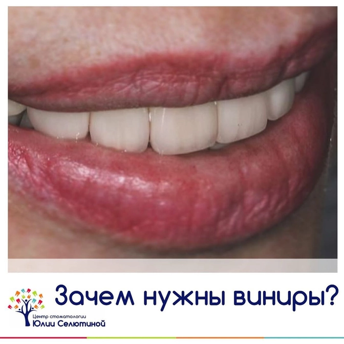 Все о винирах.