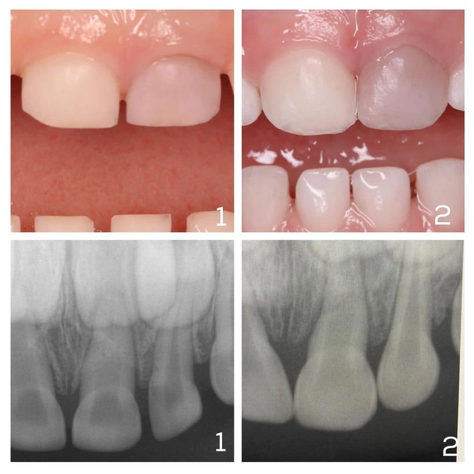 Зуб посерел: что делать? 