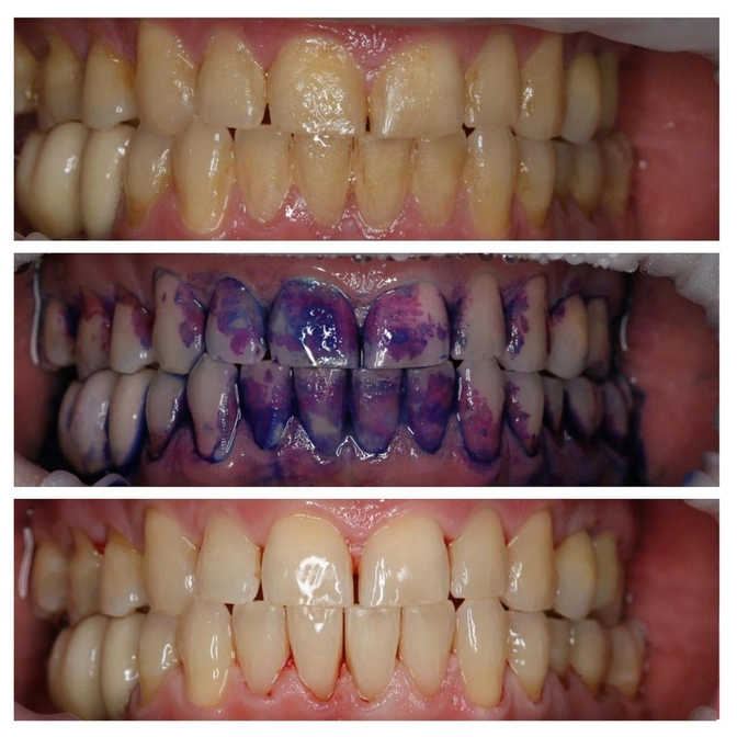 Как проверить, насколько качественно вы чистите зубы? 