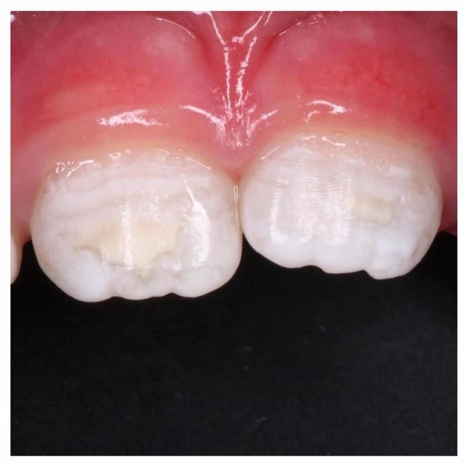 Гипоплазия эмали: почему возникает?