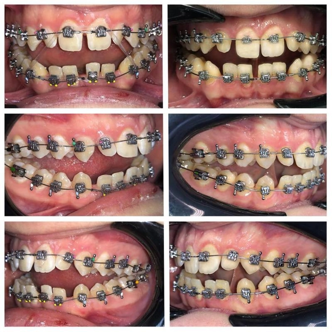 Лечение открытого прикуса на брекет-системе.