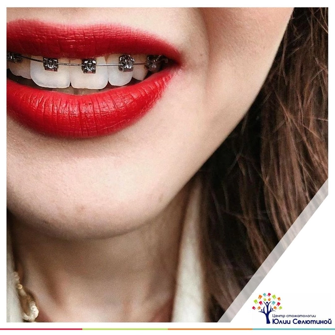 Что делать, если отклеился брекет? 