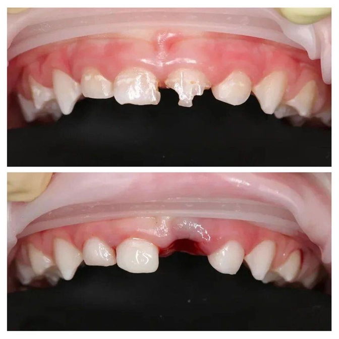 Лечение молочных зубов "во сне".