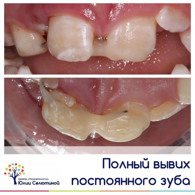 Что такое полный вывих зуба?