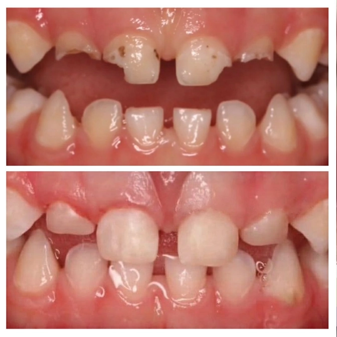 Лечение трехлетки без наркоза 