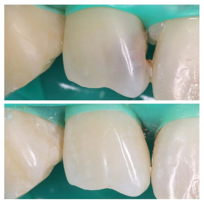 Почему важно вовремя лечить кариес? 