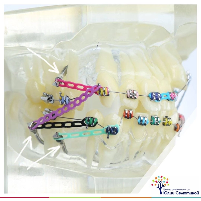 Для чего нужны мини-винты? 